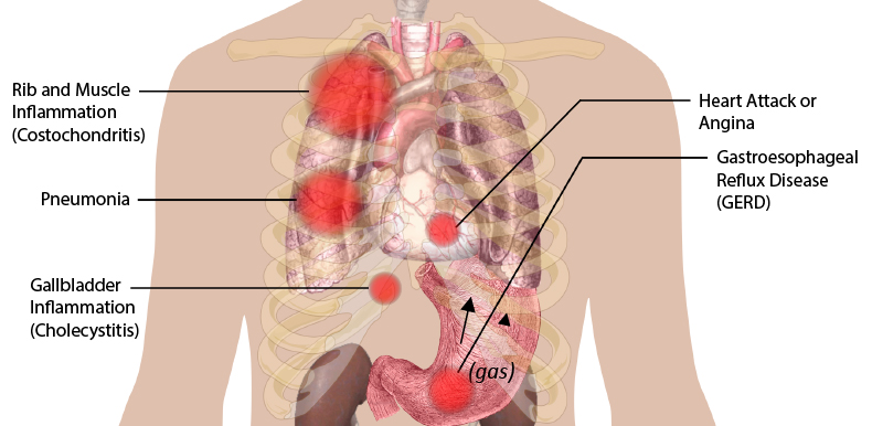 chest pain location chart